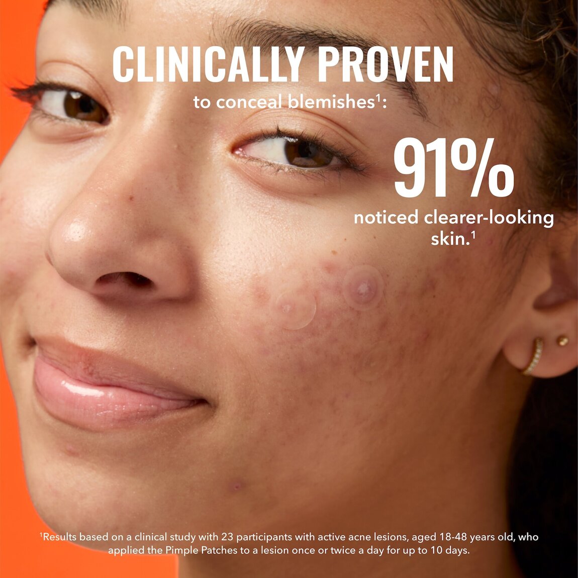 pimple-patches-v9 zb_p.jpg